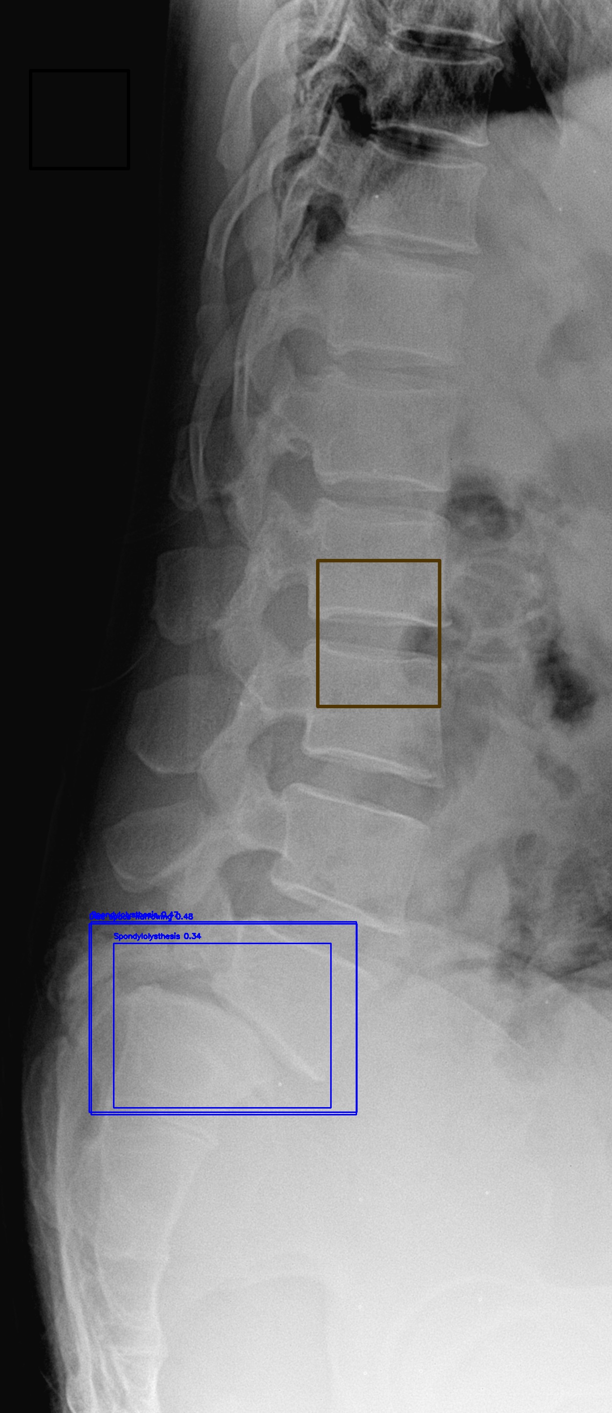 Disc Space Narrowing